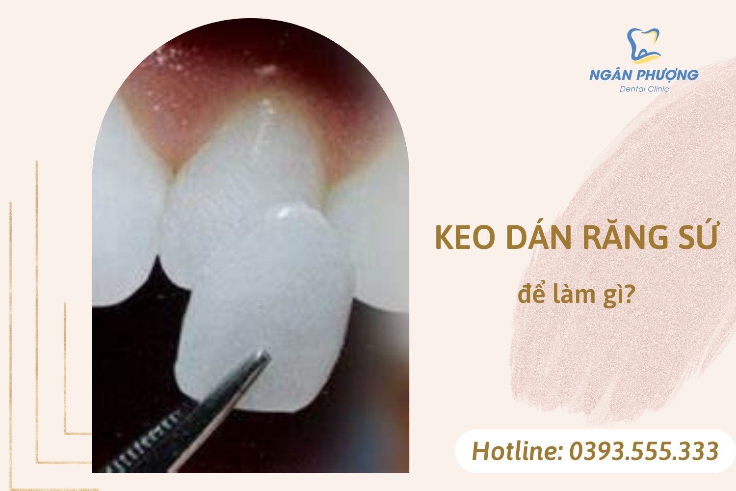 keo dan rang su de lam gi 1