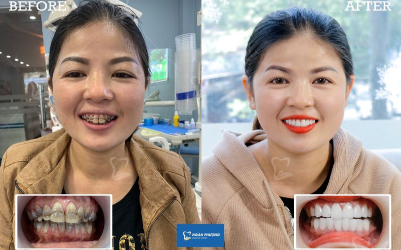 màu sắc của răng bên cạnh