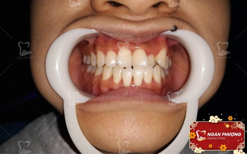 khớp cắn chưa chuẩn không nên dán răng sứ