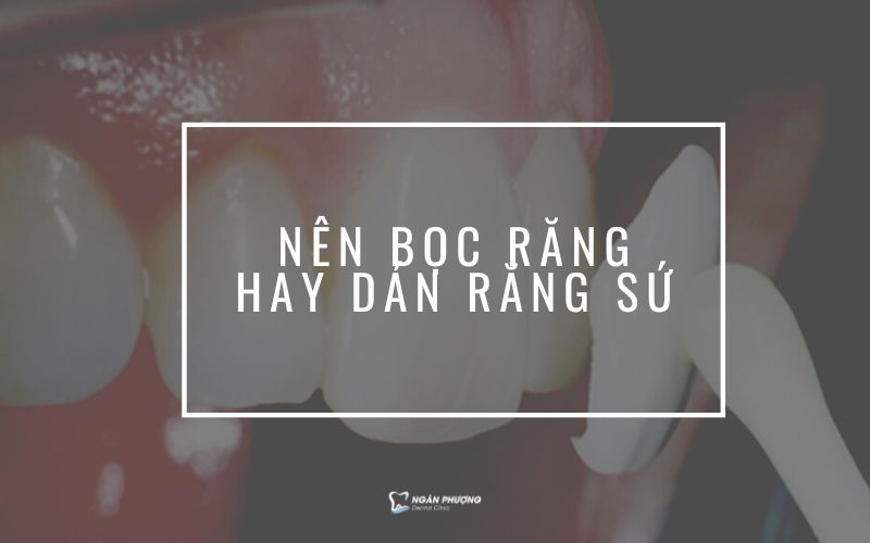 nên bọc răng sứ hay dán răng sứ