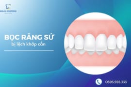 BỌC RĂNG SỨ BỊ LỆCH KHỚP CẮN CÓ ĐƯỢC KHÔNG?