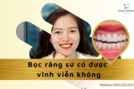 BỌC RĂNG SỨ CÓ ĐƯỢC VĨNH VIỄN KHÔNG?