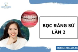 BỌC RĂNG SỨ LẦN 2 VÀ NHỮNG LƯU Ý