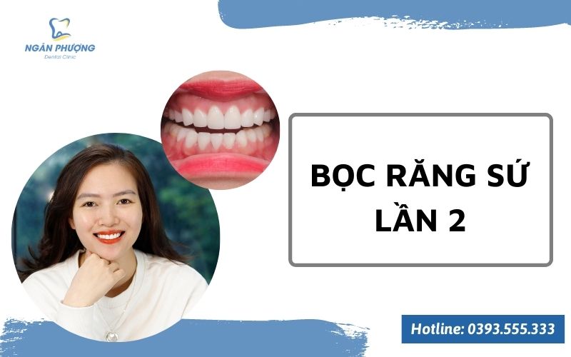 bọc răng sứ lần 2