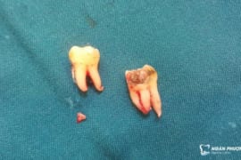 NHỔ 2 RĂNG KHÔN CÙNG LÚC CÓ ĐƯỢC KHÔNG?