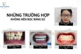NHỮNG TRƯỜNG HỢP KHÔNG NÊN BỌC RĂNG SỨ