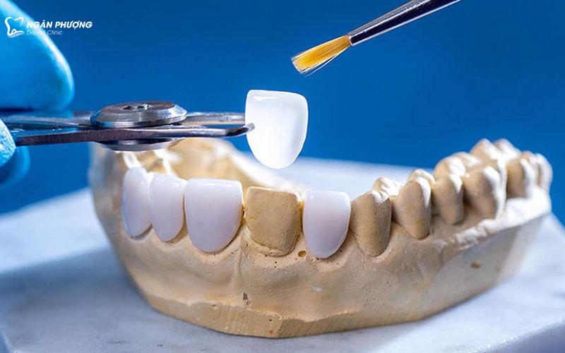 có thể là hình ảnh răng sứ trên hàm mẫu