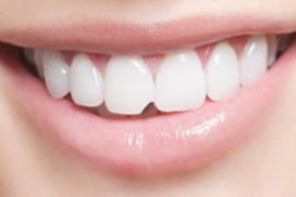 RĂNG SỨ BỊ MẺ NÊN XỬ LÝ THẾ NÀO?
