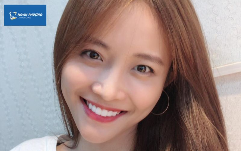 Á hậu Trương Mỹ Nhân bọc răng sứ tại nha khoa Ngân Phượng