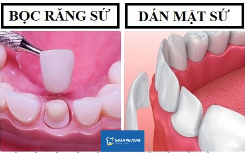 Dán răng sứ veneer đắt hơn bọc răng sứ Dán răng sứ veneer đắt hơn bọc răng sứ