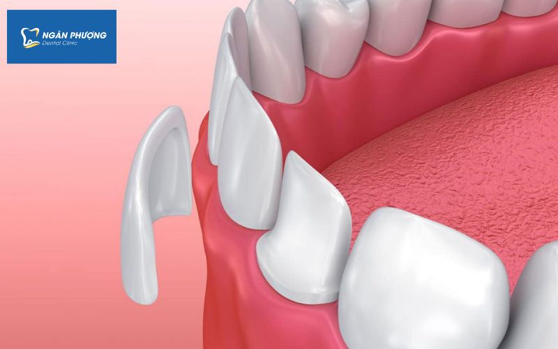 Mặt dán veneer dễ bị bong, vỡ Mặt dán veneer dễ bị bong, vỡ