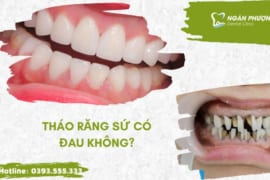 THÁO RĂNG SỨ CÓ ĐAU KHÔNG? QUY TRÌNH THÁO RĂNG SỨ TẠI NHA KHOA