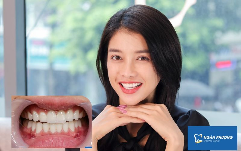 thao rang su co dau khong 3