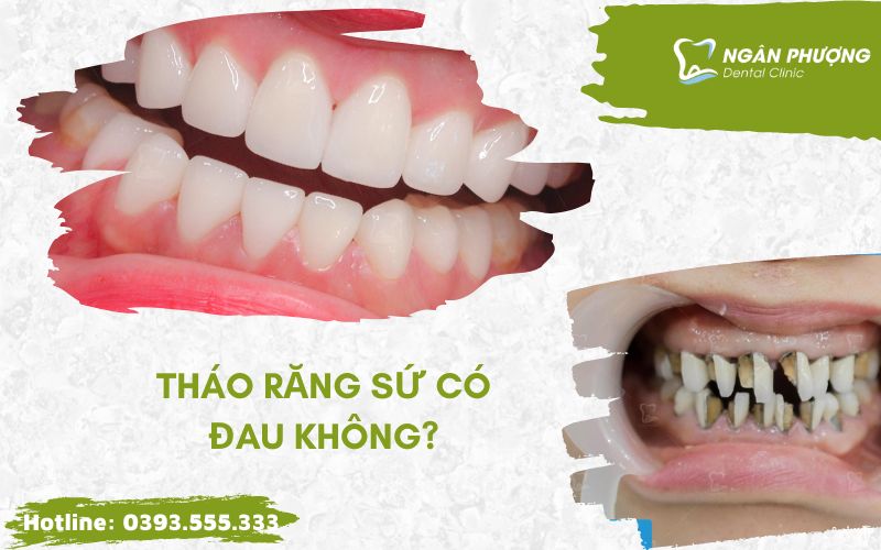 tháo răng sứ có đau không