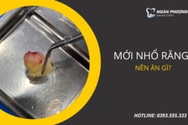 MỚI NHỔ RĂNG NÊN ĂN GÌ VÀ KHÔNG NÊN ĂN GÌ?