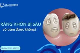 RĂNG KHÔN BỊ SÂU CÓ TRÁM ĐƯỢC KHÔNG?