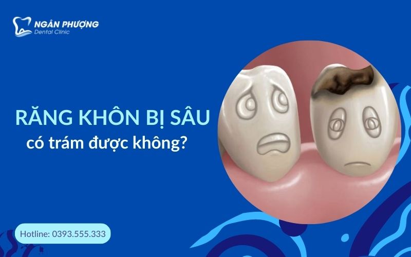 răng khôn bị sâu có trám được không