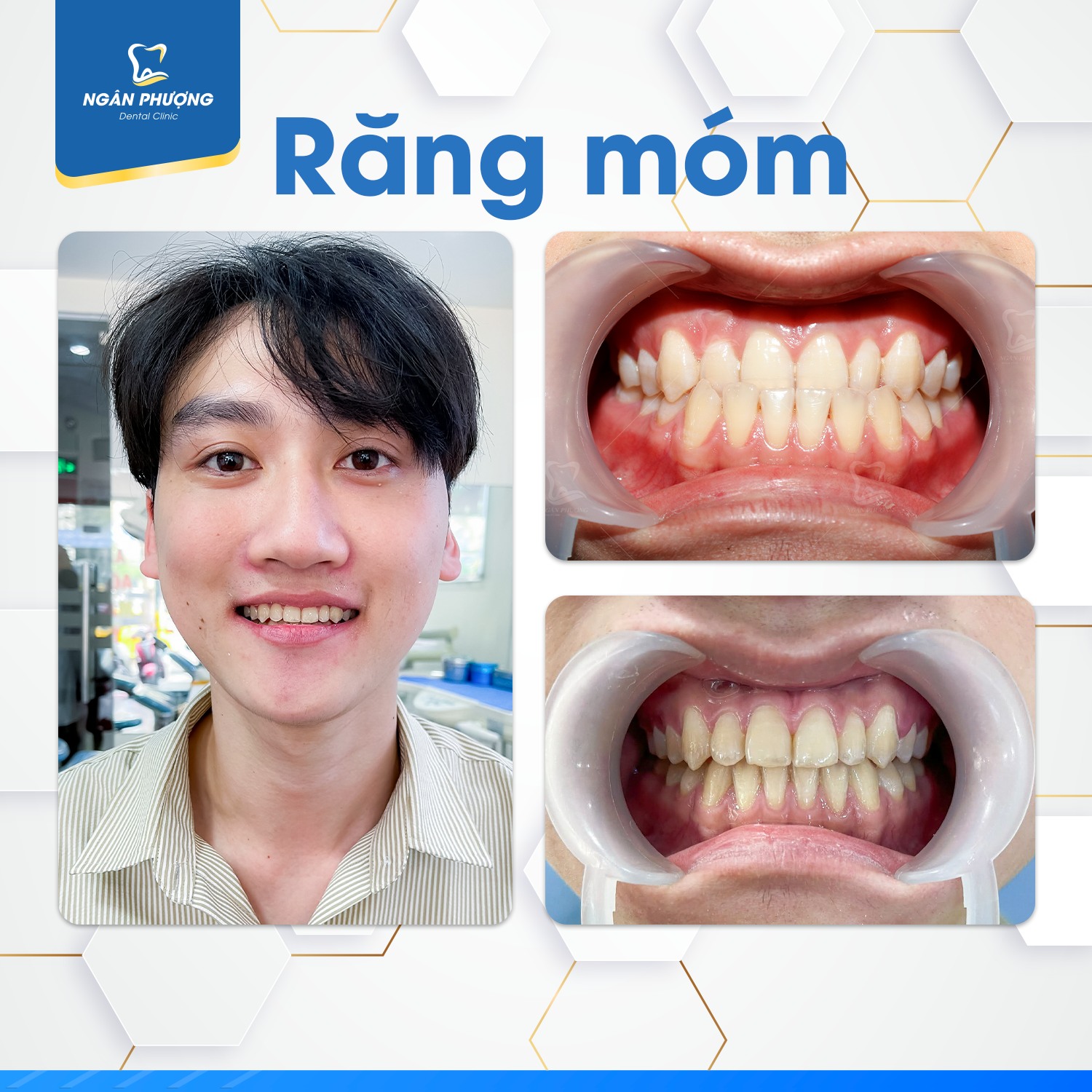 ai nên niềng răng trong suốt