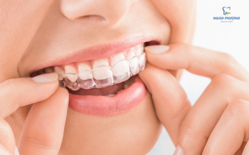 niềng răng trong suốt có hiệu quả không