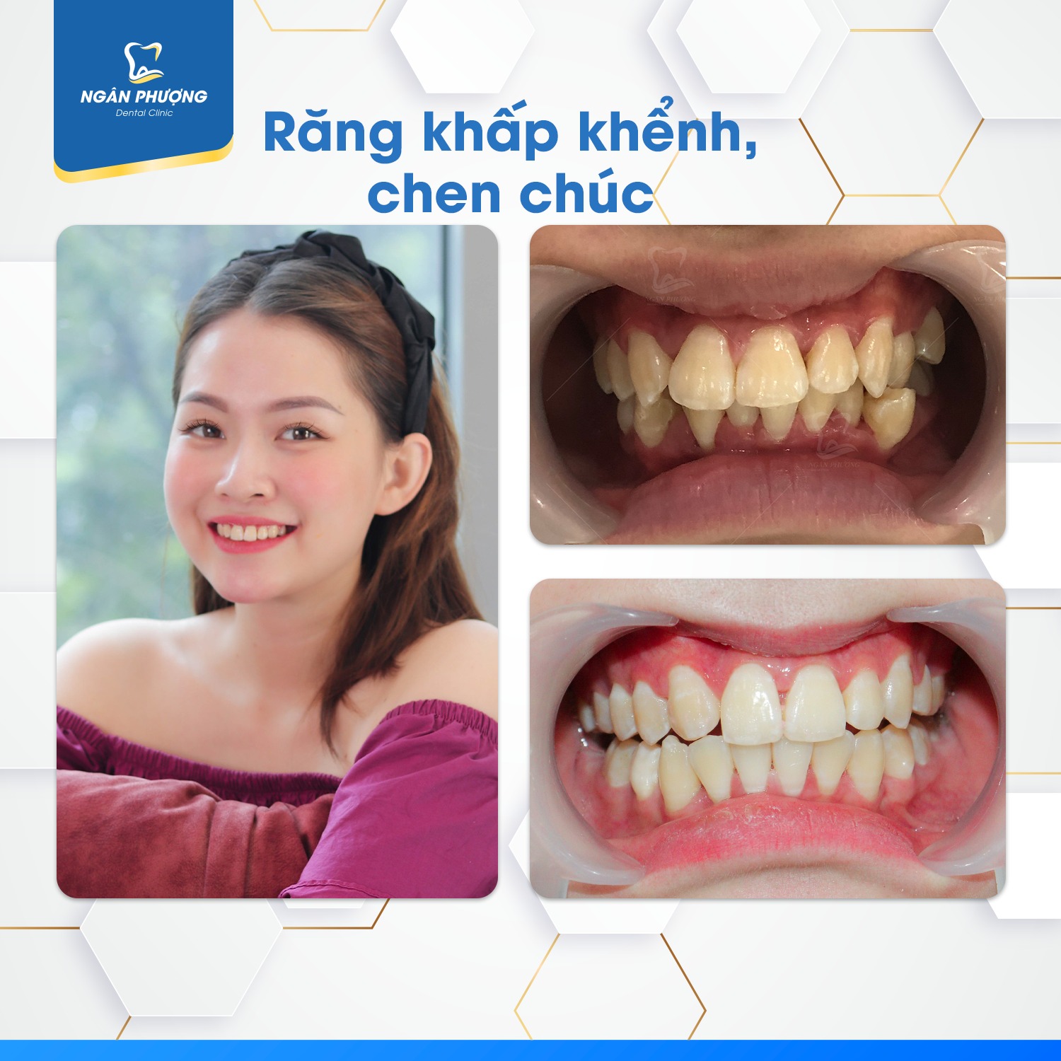 mức độ lệch lạc