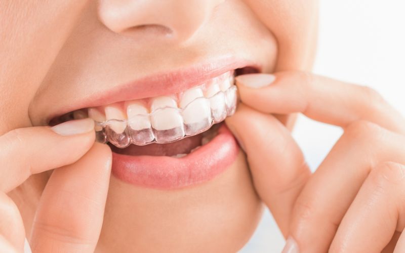 tại sao niềng răng trong suốt tại nhà được nhiều người ưa chuộng