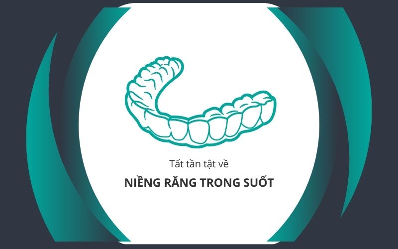 niềng răng trong suốt