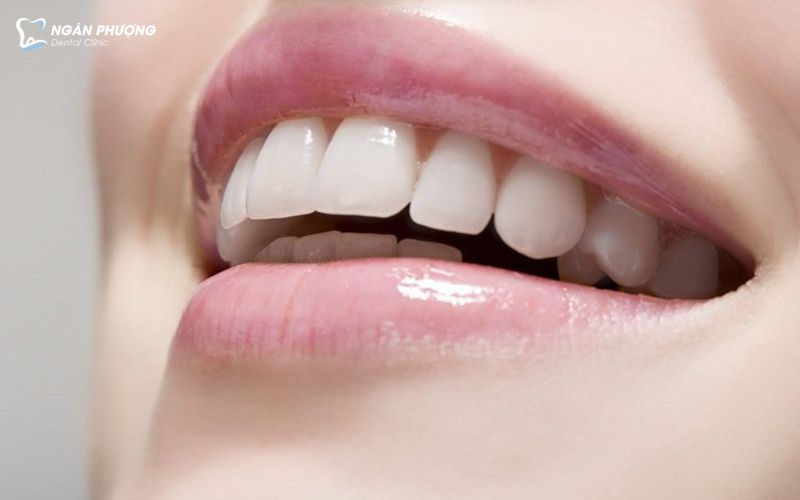 tại sao hàm duy trì trong suốt được yêu thích