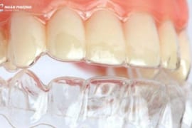 HÀM DUY TRÌ TRONG SUỐT LÀ GÌ? GIÁ HÀM DUY TRÌ TRONG SUỐT LÀ BAO NHIÊU?