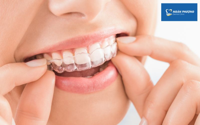 niềng răng invisalign hoạt động thế nào
