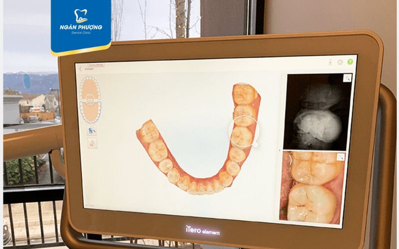 điều kiện để được niềng răng trả góp