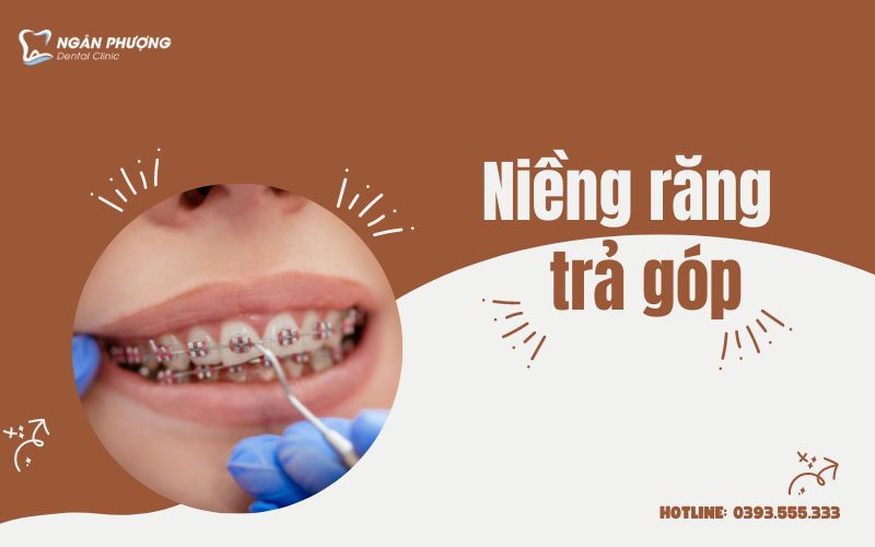 niềng răng trả góp
