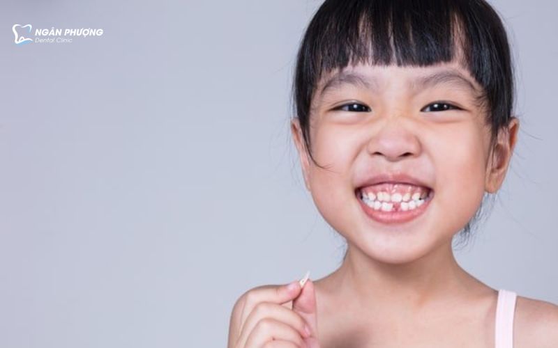độ tuổi niềng răng trong suốt cho trẻ em