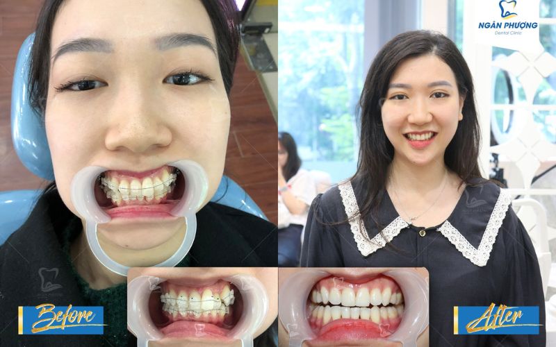 niềng răng mắc cài sứ