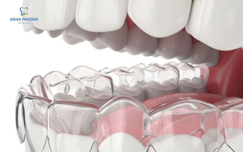 niềng răng trong suốt giá rẻ