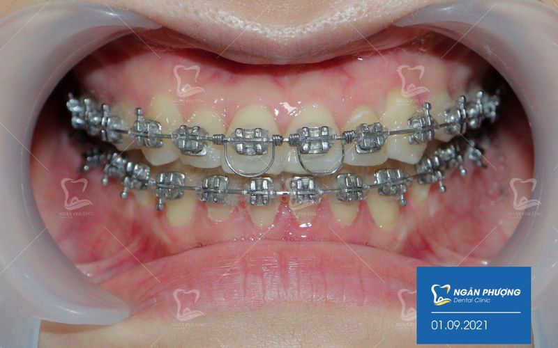 niềng răng mắc cài kim loại