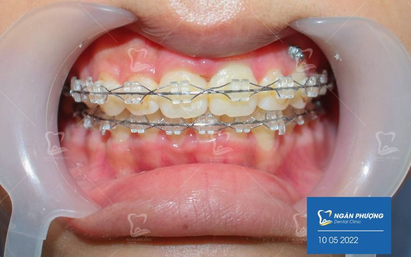 niềng răng mắc cài pha lê