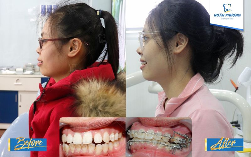 niềng răng mắc cài thường