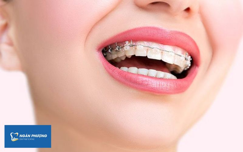 ưu điểm của niềng răng mắc cài sứ