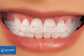 Niềng Răng Mắc Cài Sứ, Có Tốt Không?
