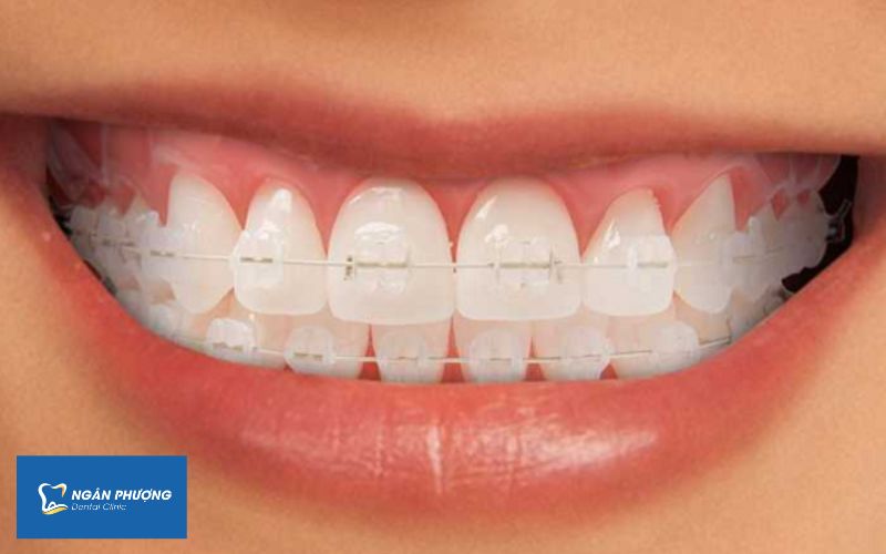 niềng răng mắc cài sứ