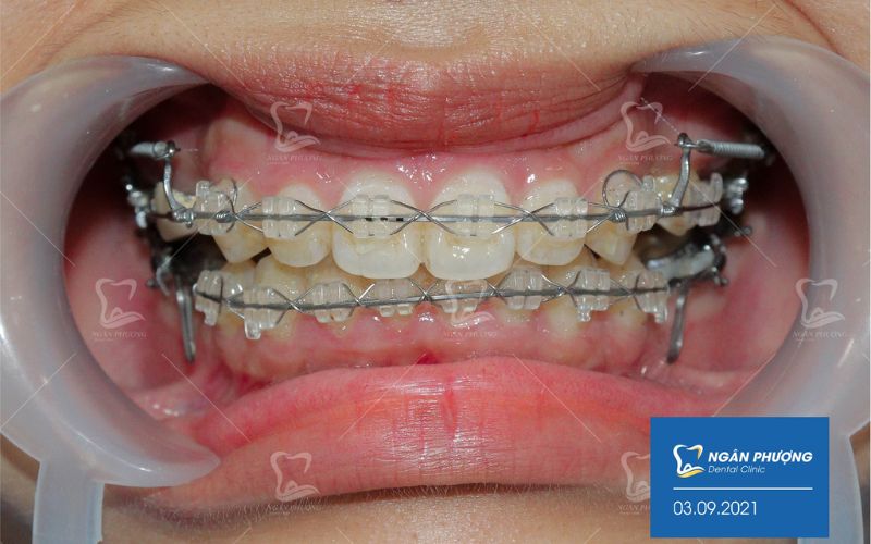 niềng răng mắc cài