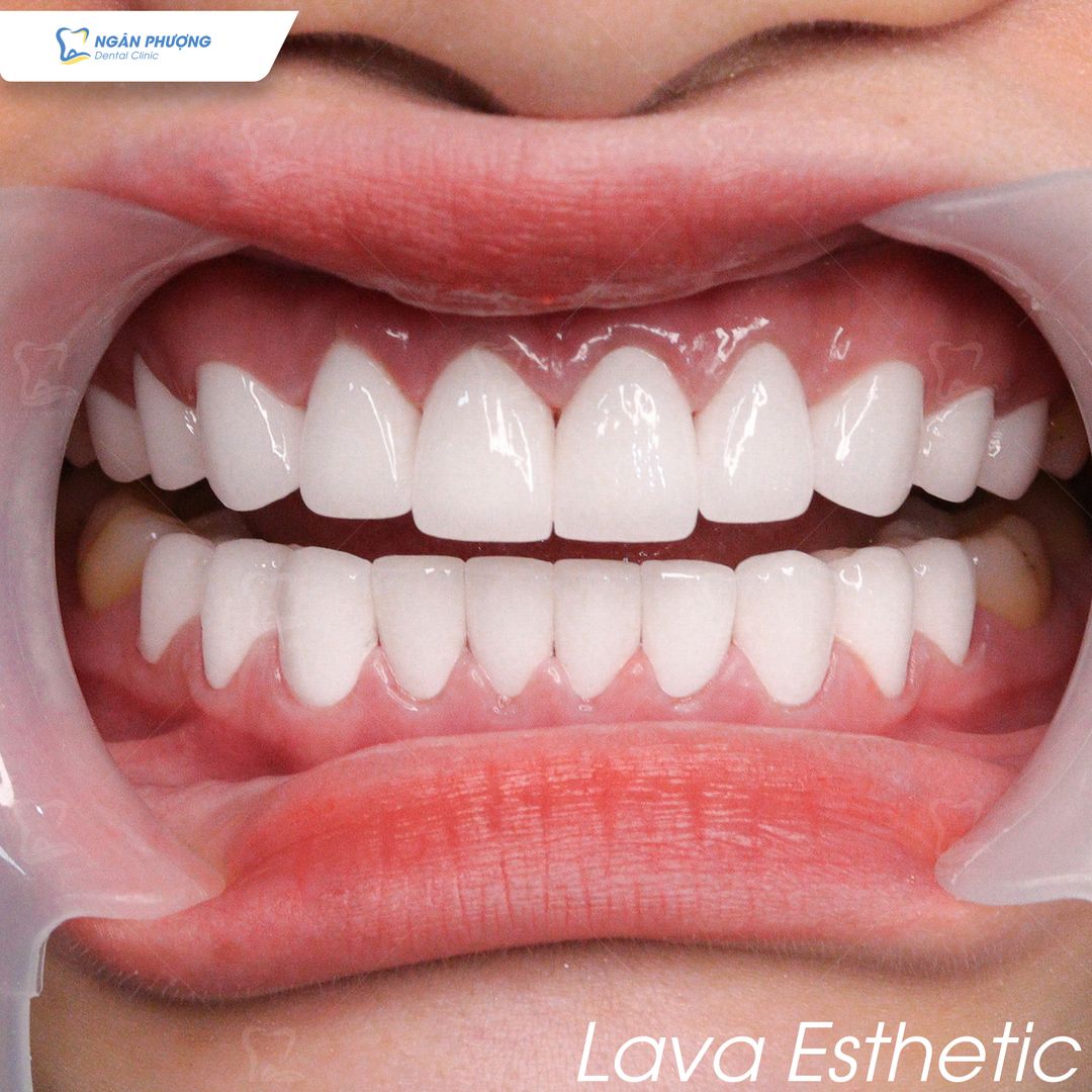 ưu điểm của răng sứ Lava