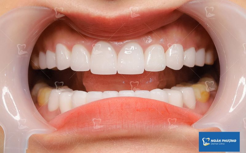 ưu điểm của răng sứ orodent