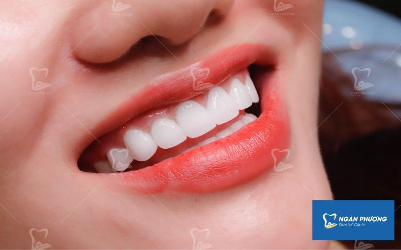 răng sứ tốt nhất hiện nay