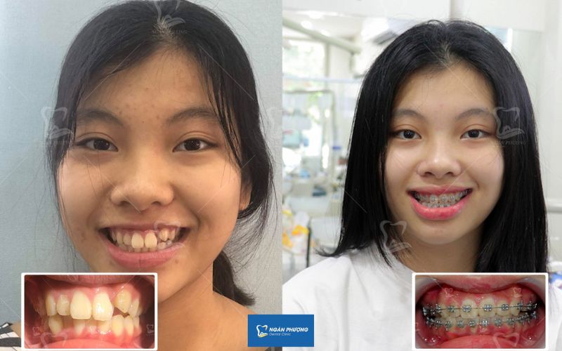 niềng răng sớm được gì