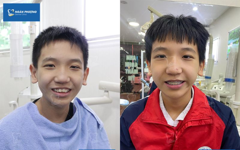 độ tuổi niềng răng