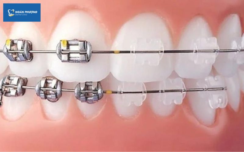 mắc cài kim loại tự buộc