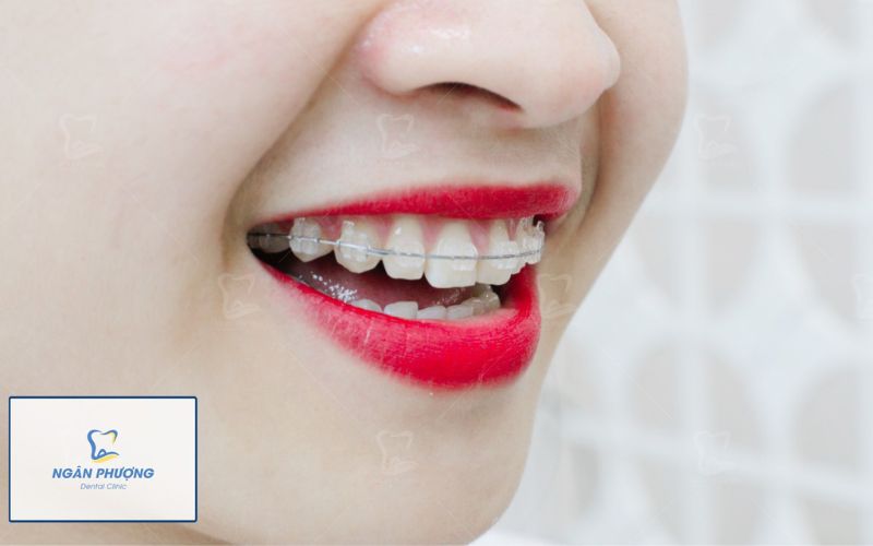 mắc cài kim loại của Mỹ