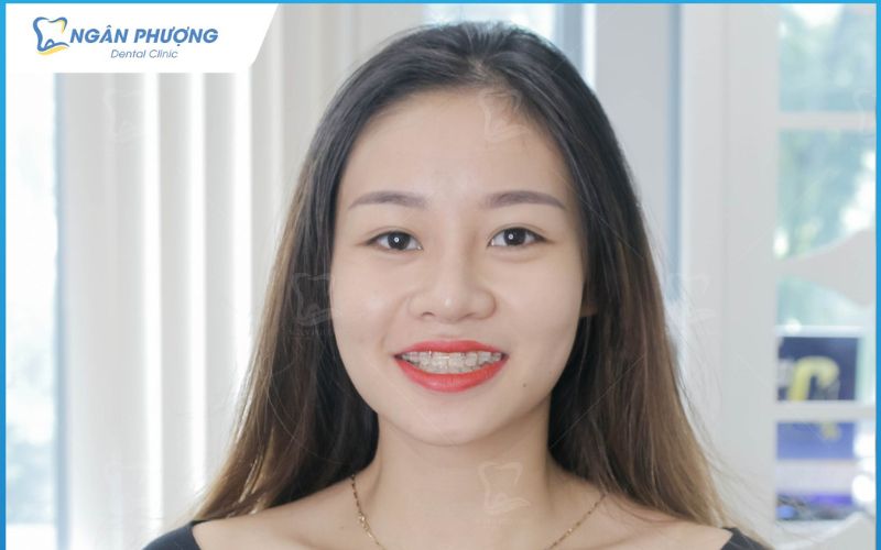 cách lựa chọn mắc cài kim loại phù hợp
