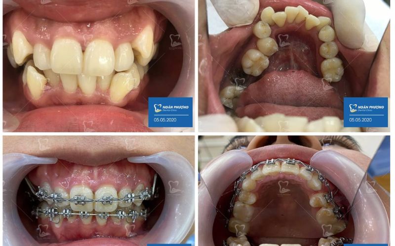 quy trình niềng răng mắc cài